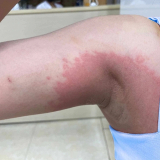 Nách bội nhiễm sau liệu trình tẩy trắng 40 triệu đồng