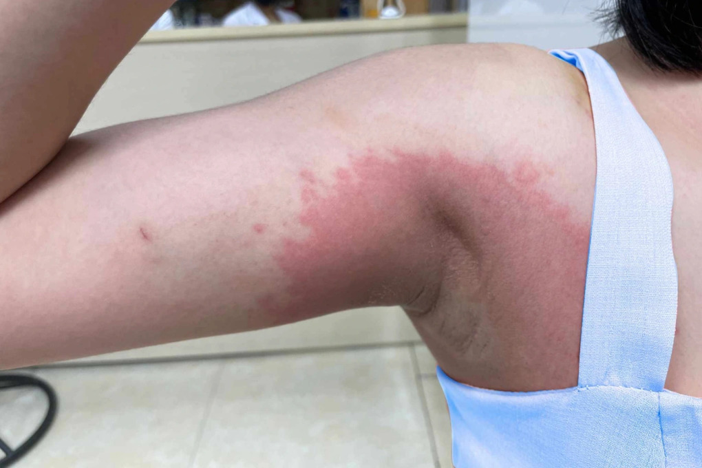 Nách bội nhiễm sau liệu trình tẩy trắng 40 triệu đồng